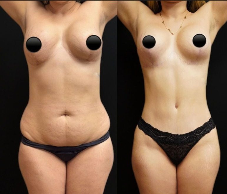 Mommy makeover, przed i po zabiegu