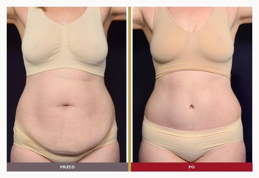 Mommy makeover, brzuch po ciąży, przed i po