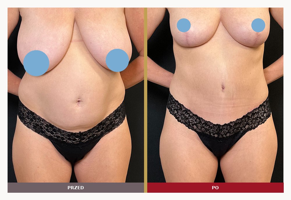 Mommy makeover, piersi i brzuch, przed i po