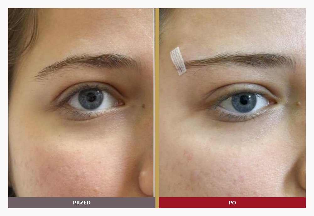 Foxy eyes, uniesienie kącika oka, przed i po