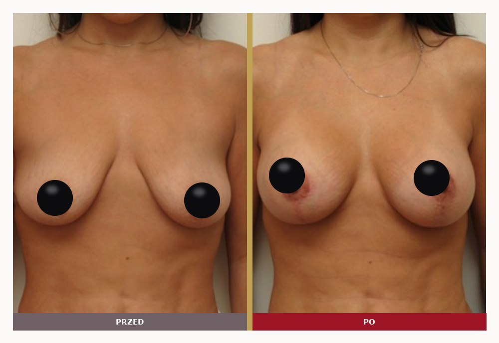 Lifting piersi z implantami, przed i po