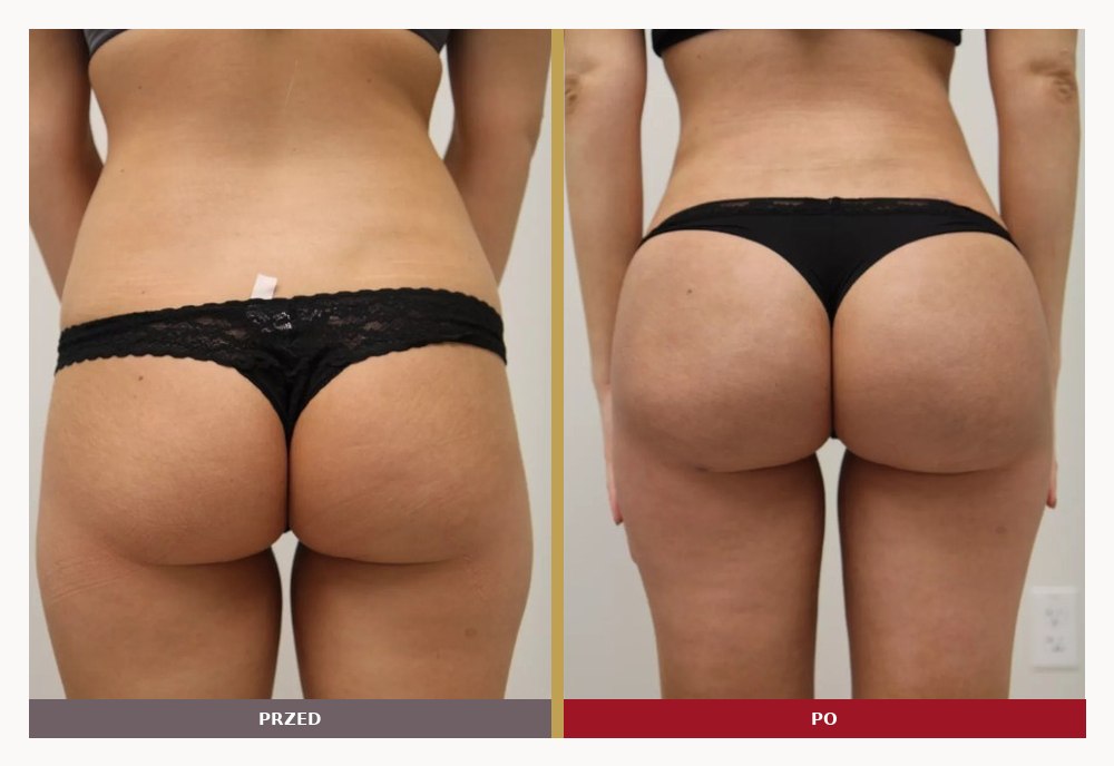 Liposukcja i modelowanie pośladków, przed i po
