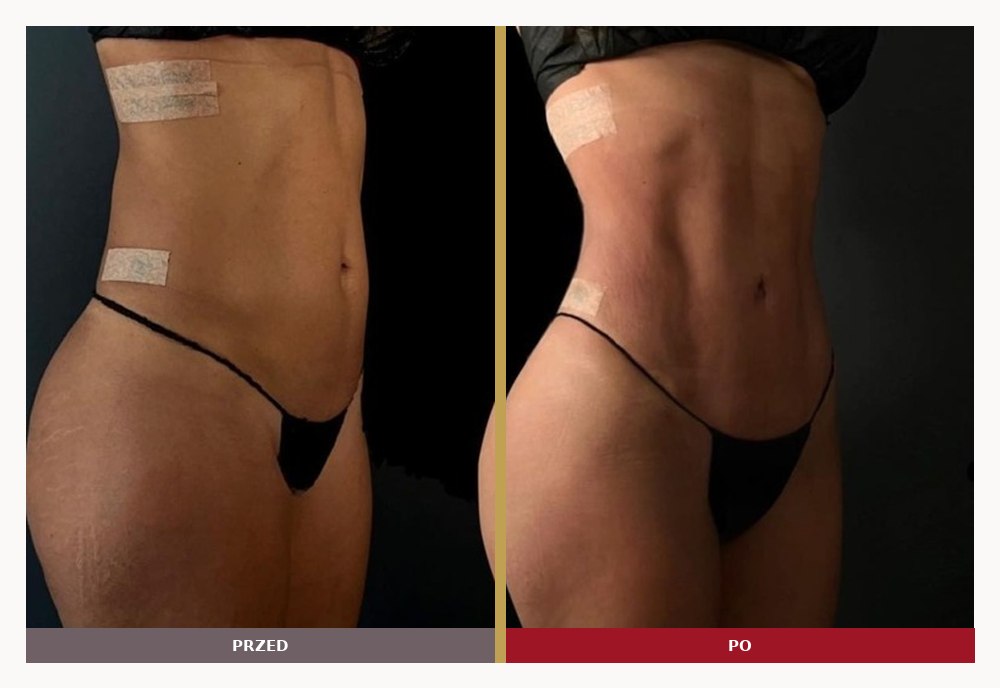 Six pack, rzeźbienie mięśni brzucha, przed i po