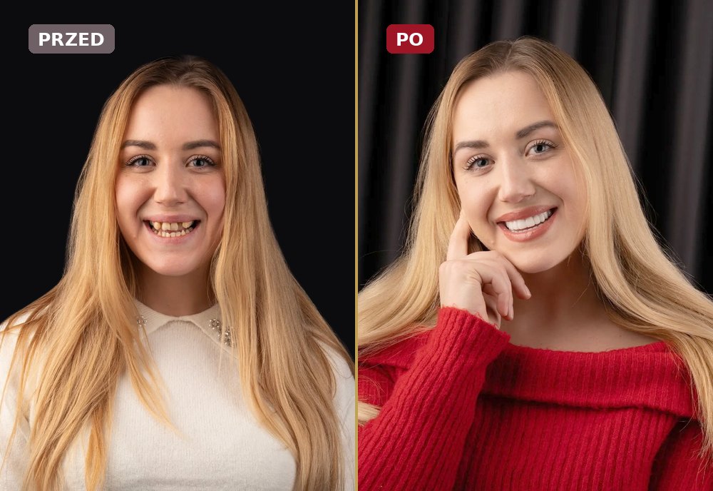 Stomatologia estetyczna, zdjęcia przed i po zabiegu